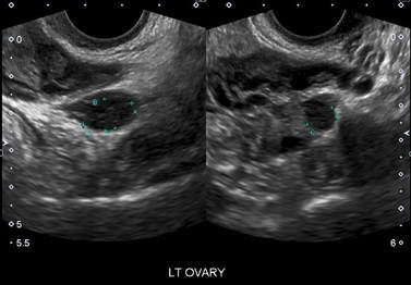 What we Weren’t Taught About Endometriosis